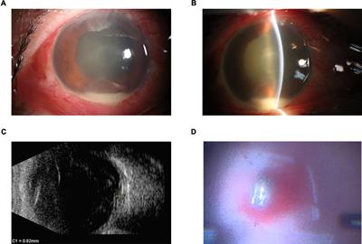 Case report: Emerging species in post-traumatic endophthalmitis: Acinetobacter johnsonii